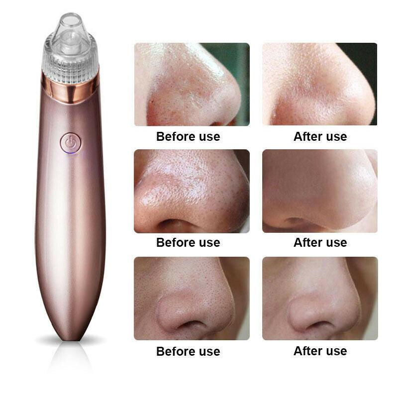 Electric Blackhead Vacuum Pore Cleaner Acne Pimple Remover Strong Suction Tool Electric Blackhead Remover Pore Vacuum Suction Diamond Dermabrasion Face Cleaner.